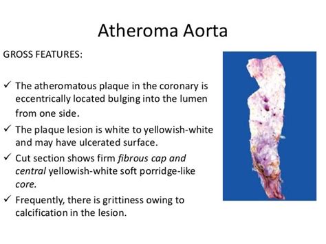 what is atheromatous aorta in tagalog|Ateroma .
